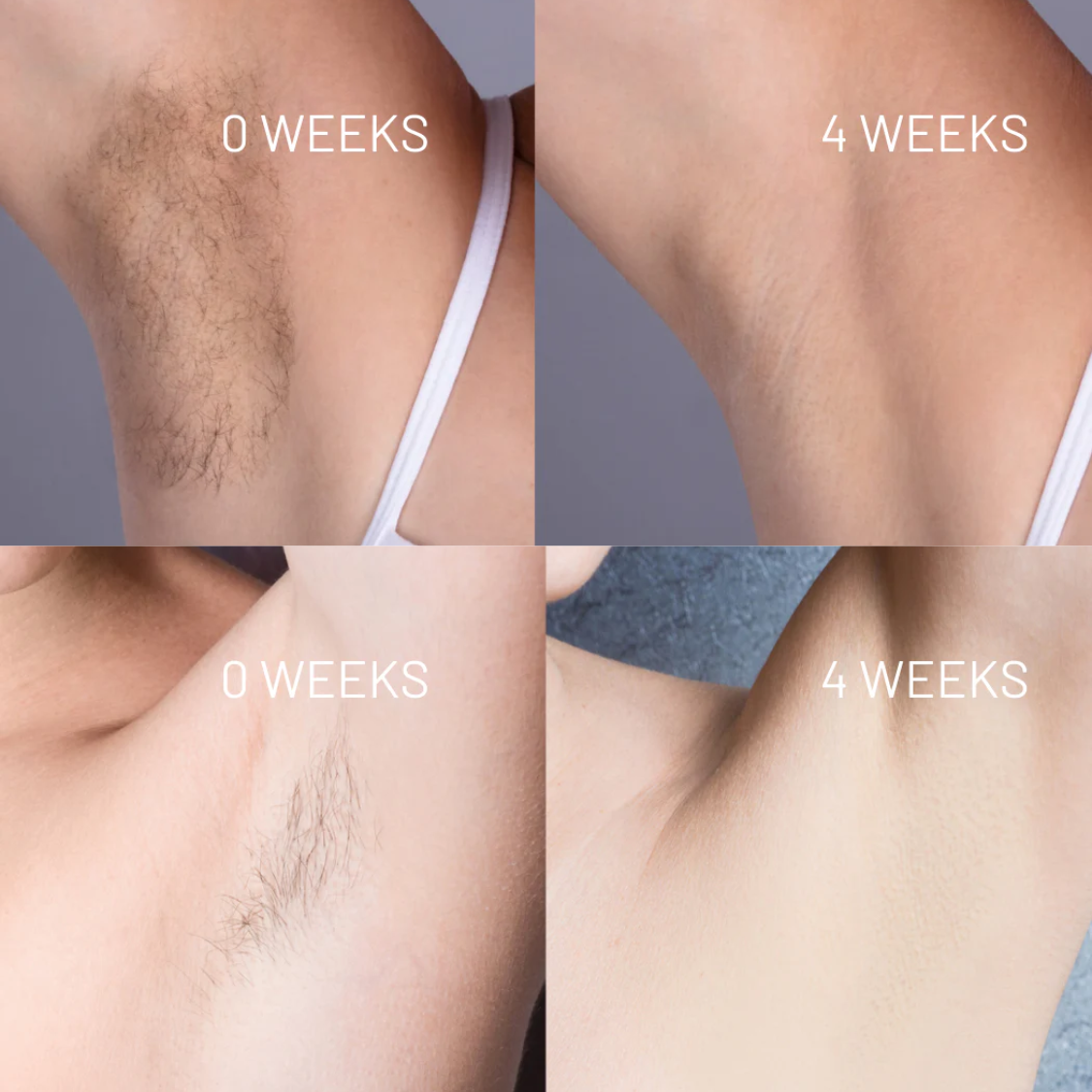 Nudae™ - Oil for Natural Permanent Hair Reduction