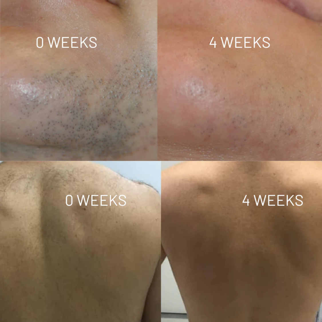 Nudae™ - Oil for Natural Permanent Hair Reduction