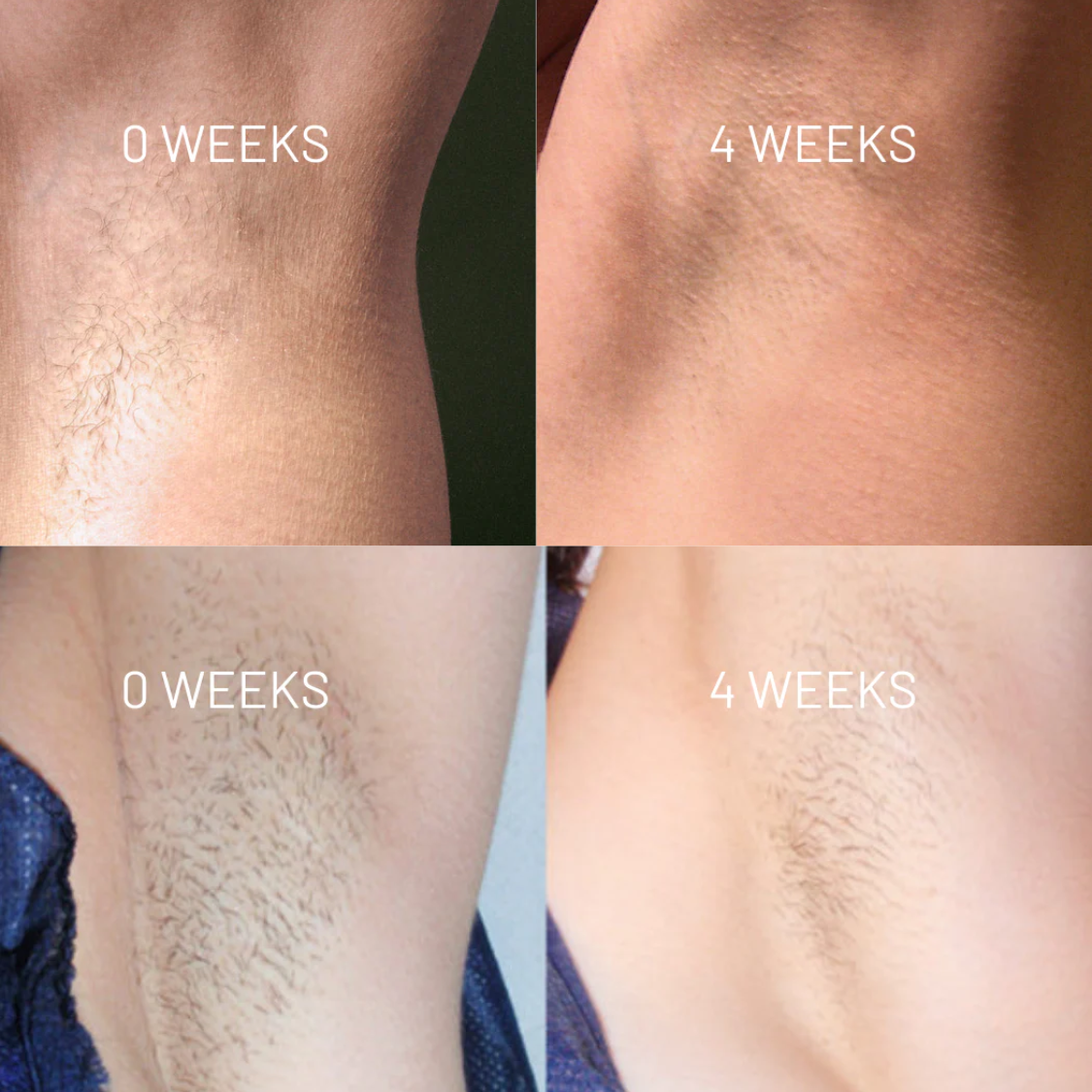 Nudae™ - Oil for Natural Permanent Hair Reduction