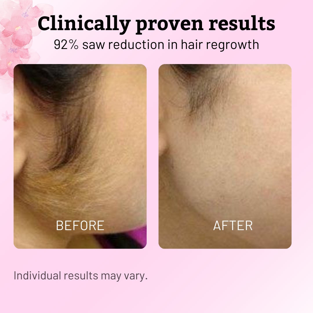 Nudae™ - Oil for Natural Permanent Hair Reduction