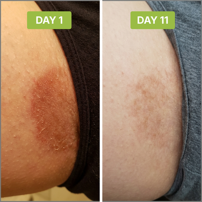 ClearSkin™ - Stops Groin Irritation and Odor at the Source.