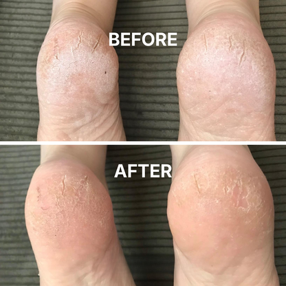 SkinFix - Target cracked, rough skin fast. Wake up to softer skin.