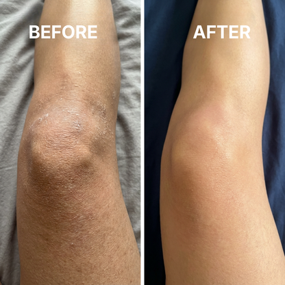 SkinFix - Target cracked, rough skin fast. Wake up to softer skin.