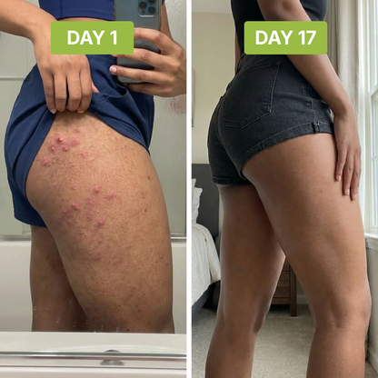 ClearSkin™ - Stops bumps and ingrowns at the source.