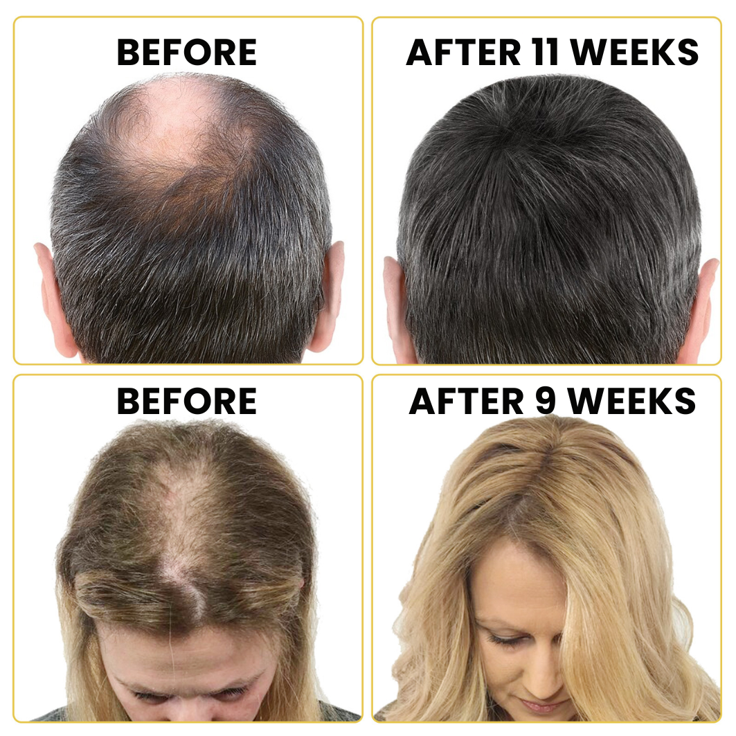 GrowthFuel™ – Hair & Beard Serum 5% Minoxidil