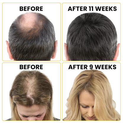 GrowthFuel™ – Hair & Beard Serum 5% Minoxidil
