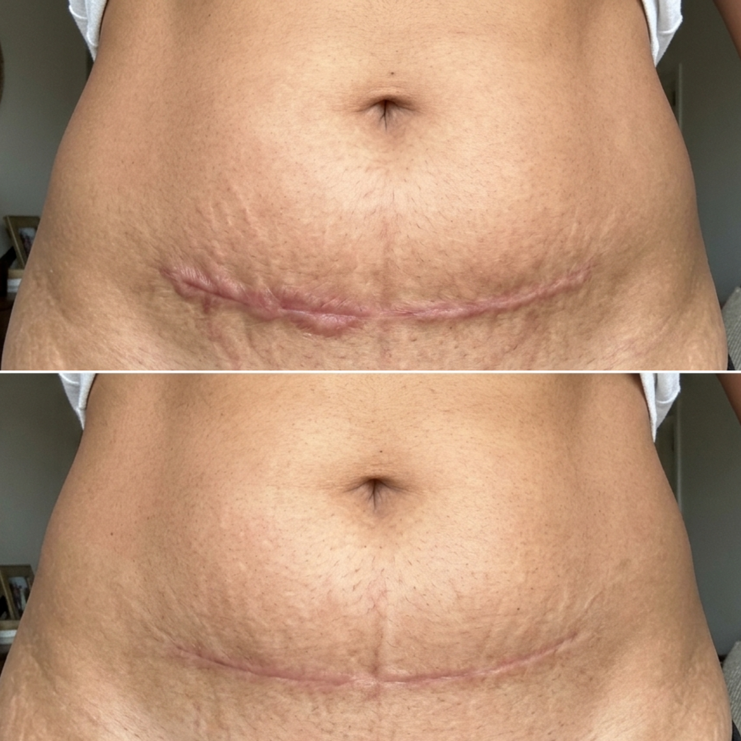 Silicone Scar Sheets - Scar Away Advanced