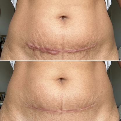 Silicone Scar Sheets - Scar Away Advanced