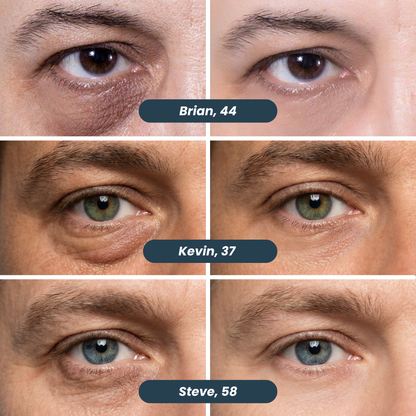 SYLK Microneedle Patches