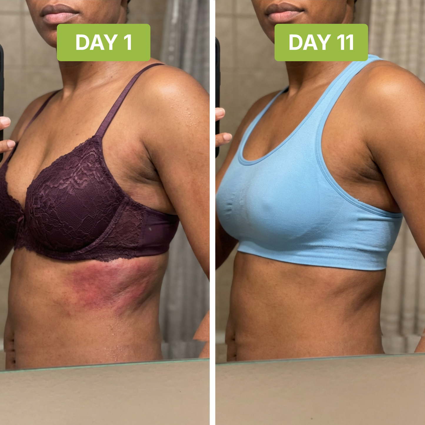 ClearSkin™ - Treats underboob rash in one week.