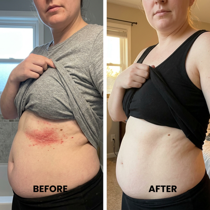 ClearSkin™ - Clears skin fold rash in as little as one week.