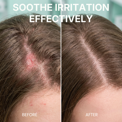 Pre-Shampoo Exfoliating for Dry, Flaky Scalp