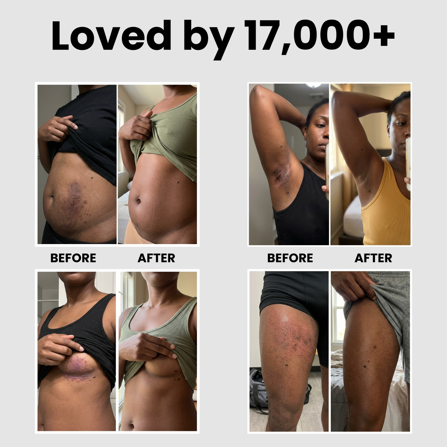 ClearSkin™ - Clears skin fold rash in as little as one week.