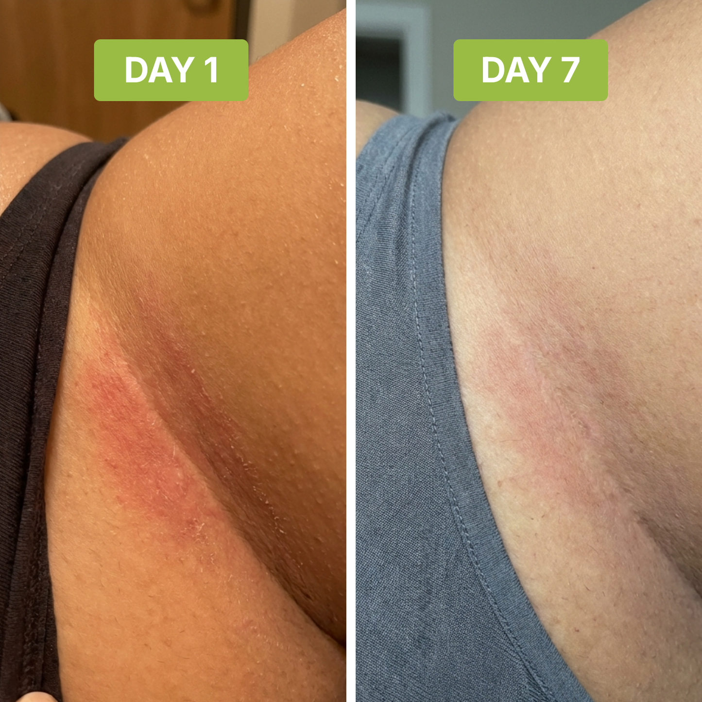 ClearSkin™ - Stops Groin Irritation and Odor at the Source.
