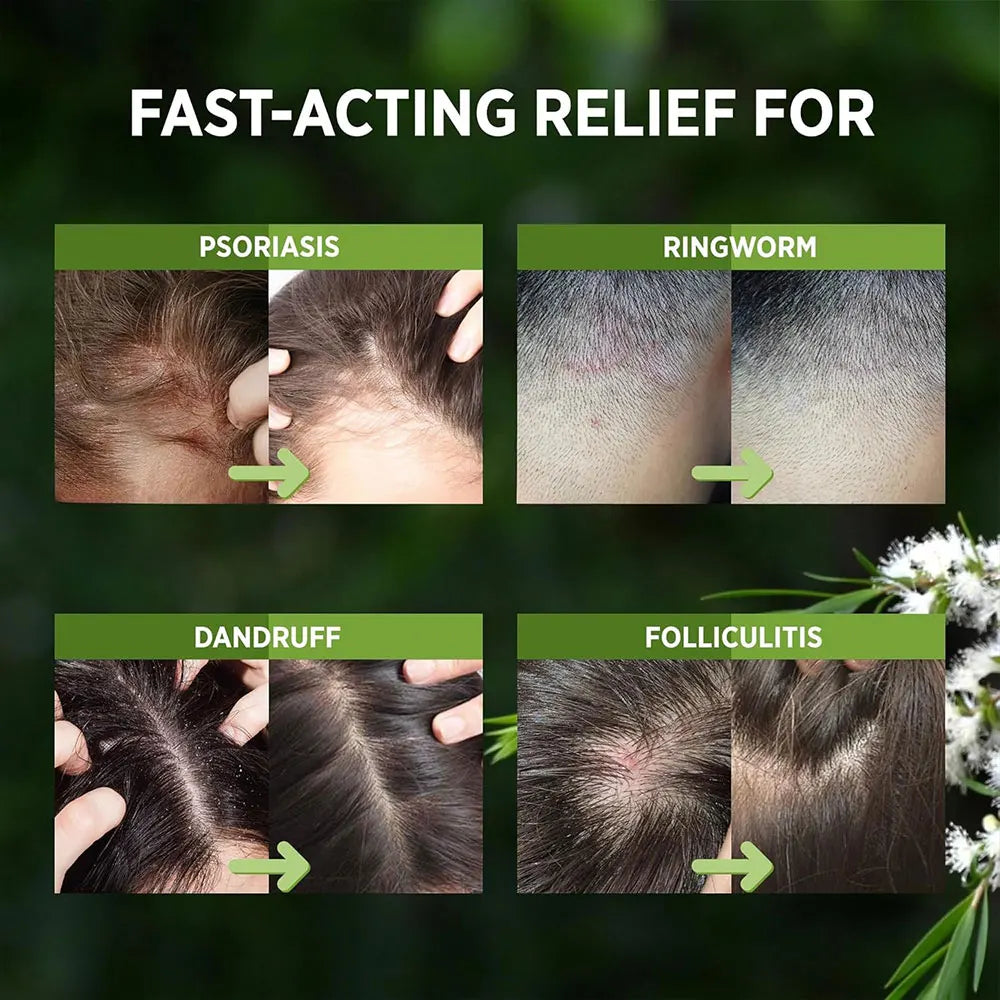 Scalf Relief Spray for Dry, Flaky & Itchy Scalp