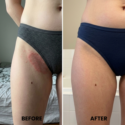 ClearSkin™ - Clears skin fold rash in as little as one week.